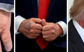 bruised hands and profile view of a man in a suit, intense focus